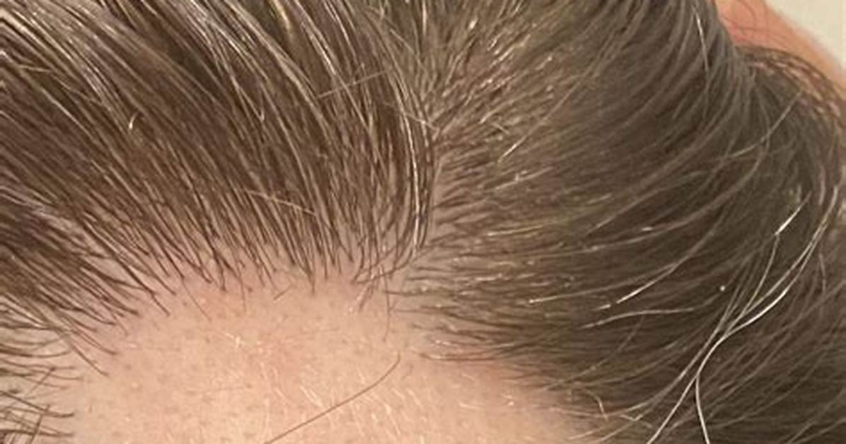 What Are the Little White Hairs on My Breast?