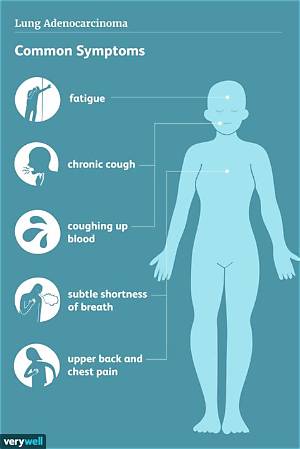 What Are the Symptoms of Lung Adenocarcinoma?