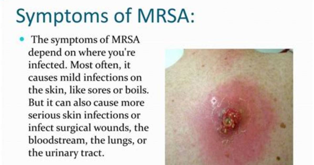 What Are the Symptoms of Mrsa in Your Nose?