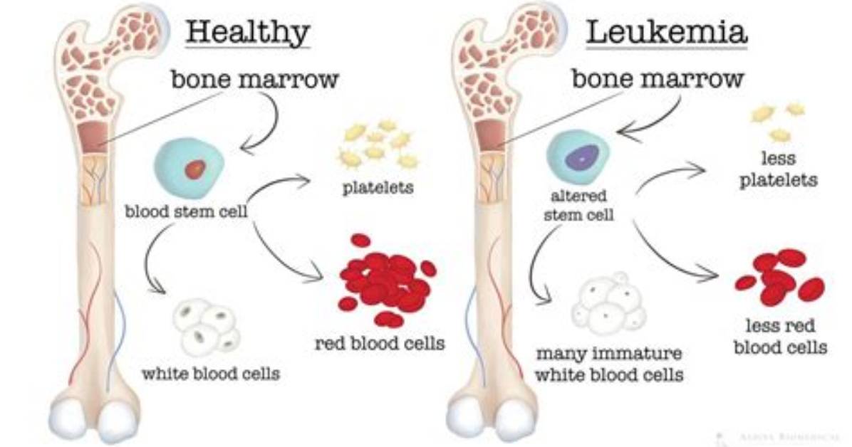 What Bones Are Affected by Leukemia?
