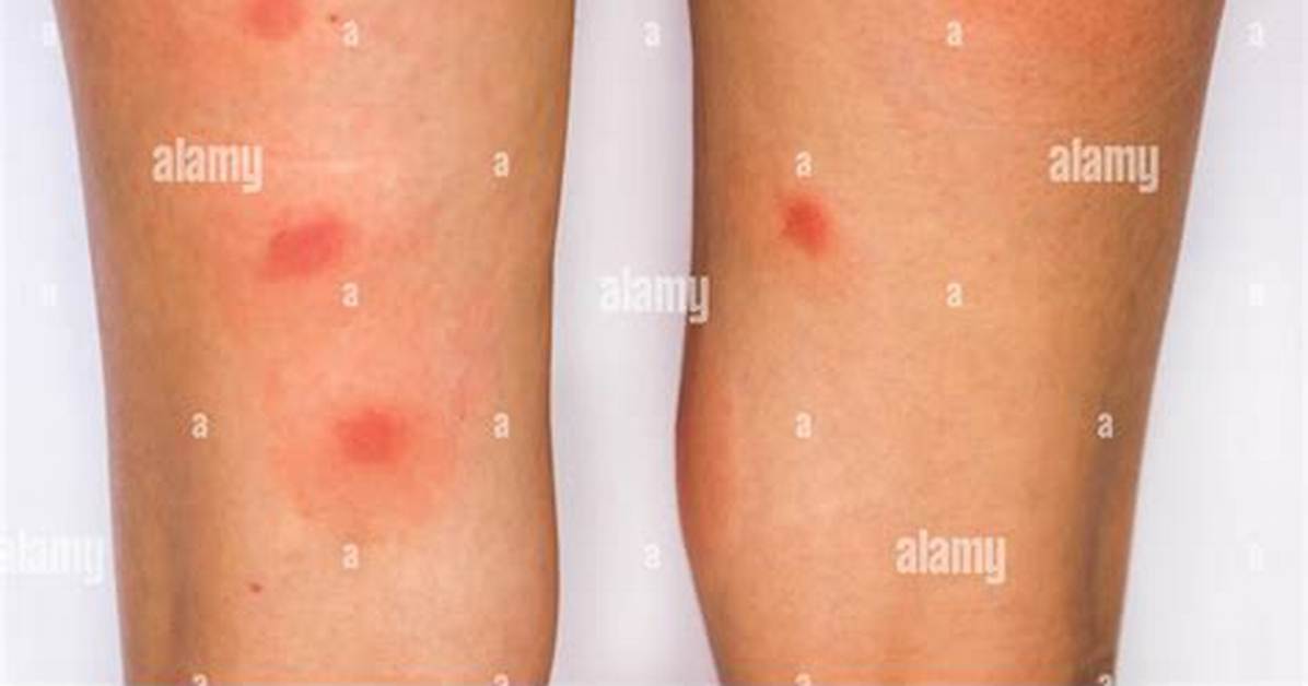What Bug Bite Leaves a Big Red Circle?