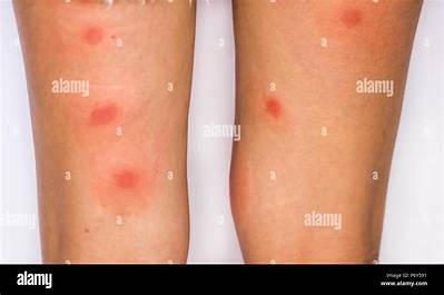 What Bug Bite Leaves a Big Red Circle?