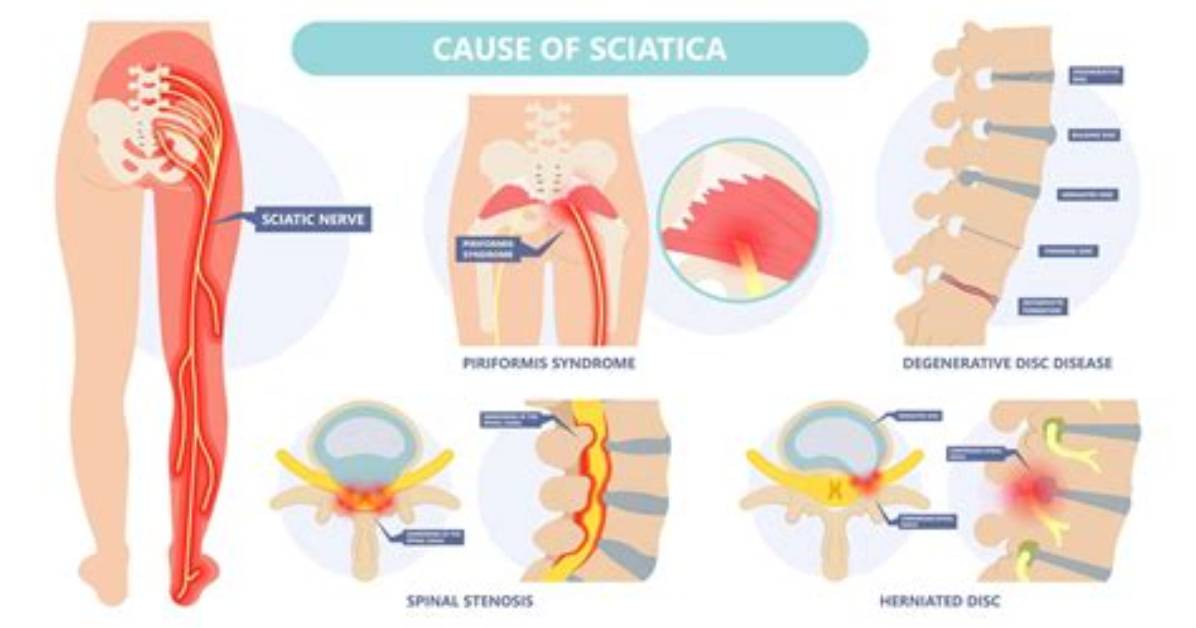 What Can Aggravate Your Sciatica?