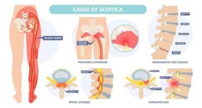 What Can Aggravate Your Sciatica?