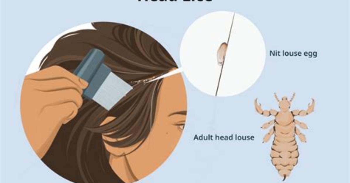 What Can Lice Do to You?