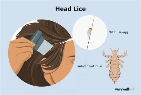 What Can Lice Do to You?