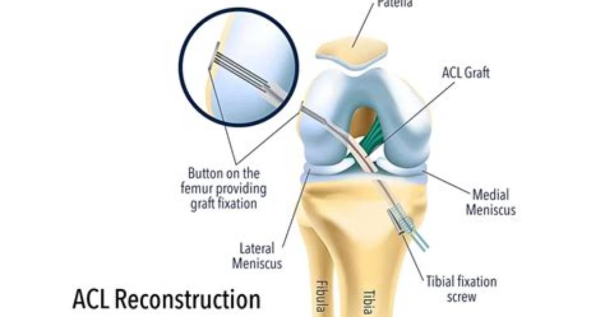 What Can Stretch Acl Graft?