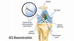 What Can Stretch Acl Graft?