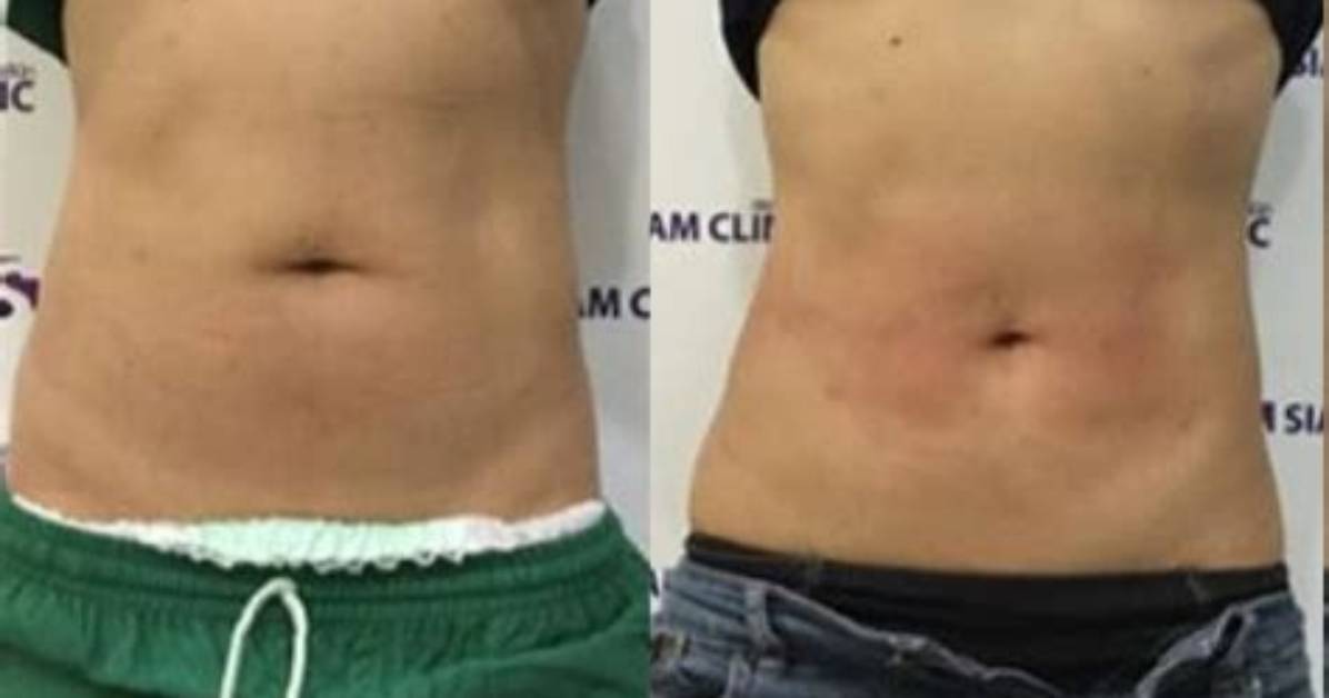 What Can You Eat After Liposuction?