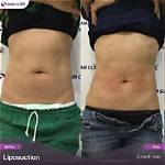 What Can You Eat After Liposuction?