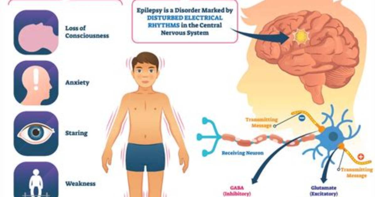 What Causes Epilepsy?