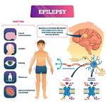 What Causes Epilepsy?