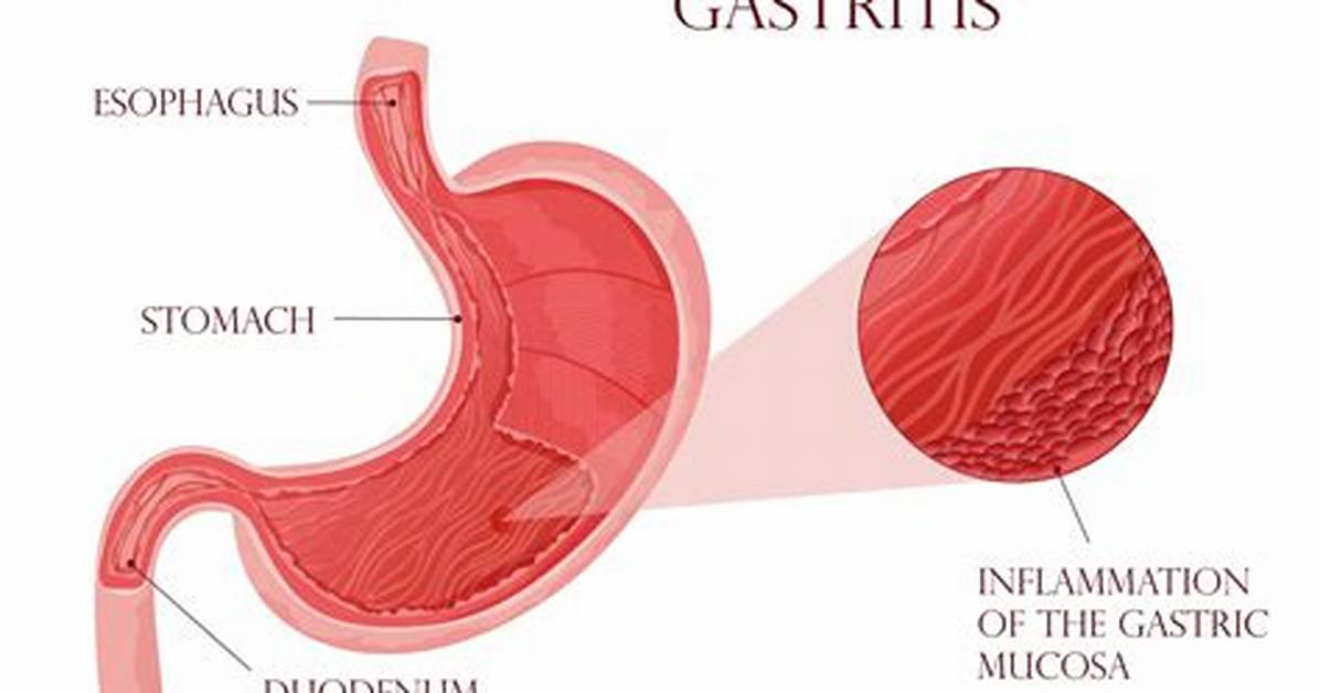 What Causes Inflammation of Stomach Lining?