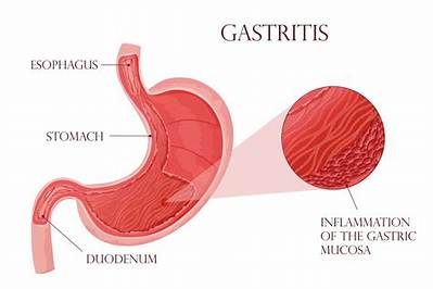 What Causes Inflammation of Stomach Lining?