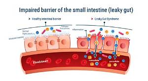 What Causes Leaky Gut?