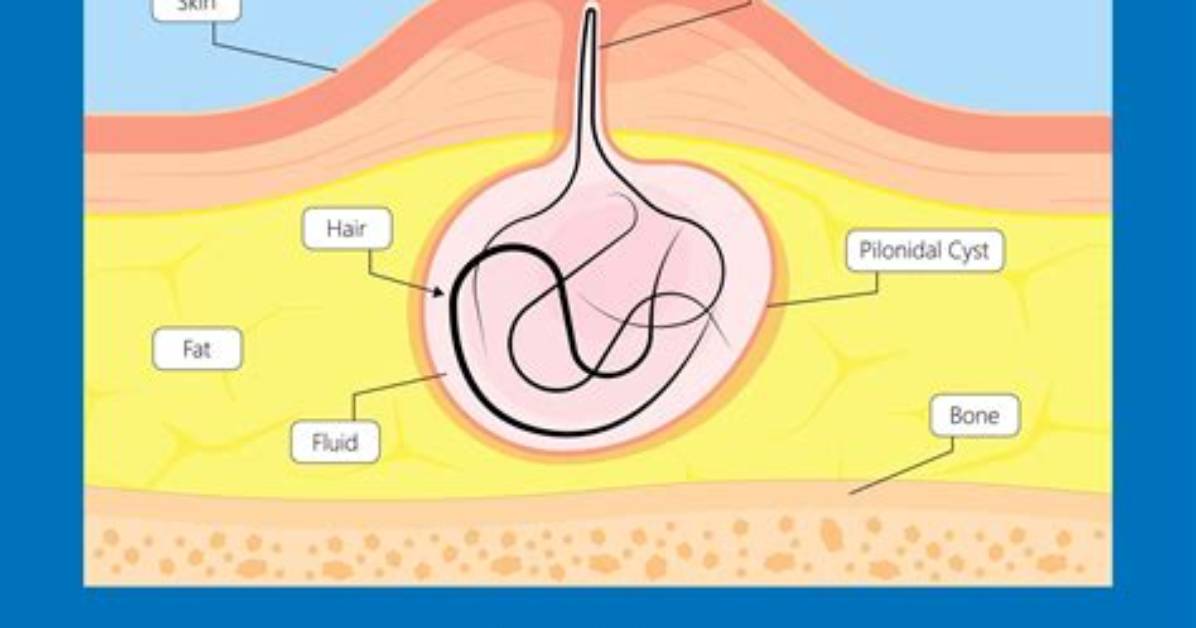 What Causes Pilonidal Cyst to Flare up?