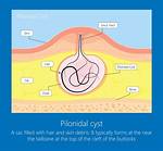 What Causes Pilonidal Cyst to Flare up?