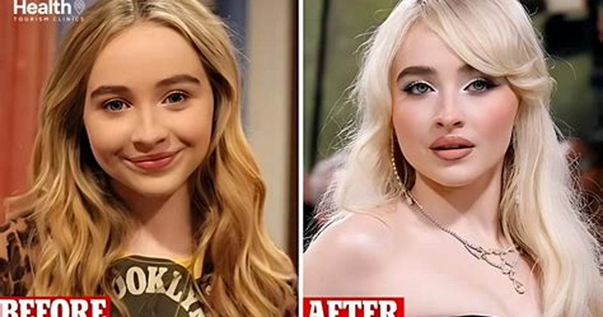 What Cosmetic Procedures Has Sabrina Carpenter Undergone?
