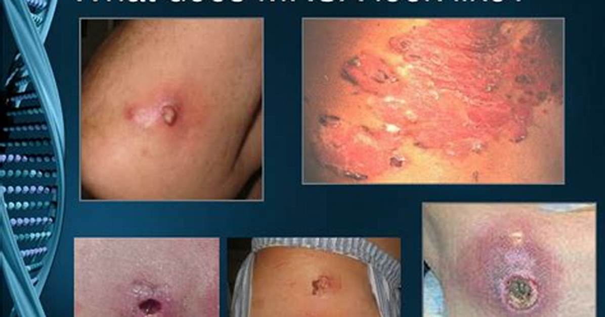 What Dies Mrsa Look Like?