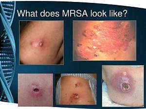 What Dies Mrsa Look Like?