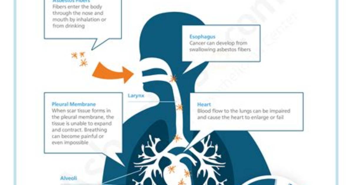 What Diseases Can Be Caused by Asbestos?