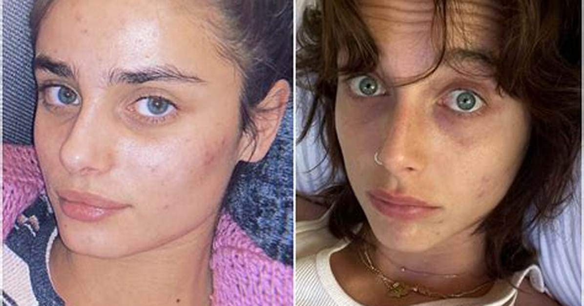 What Do Celebrities Use for Acne: the Ultimate Guide to Achieving Flawless Skin