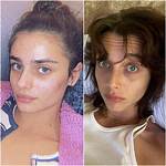 What Do Celebrities Use for Acne: the Ultimate Guide to Achieving Flawless Skin