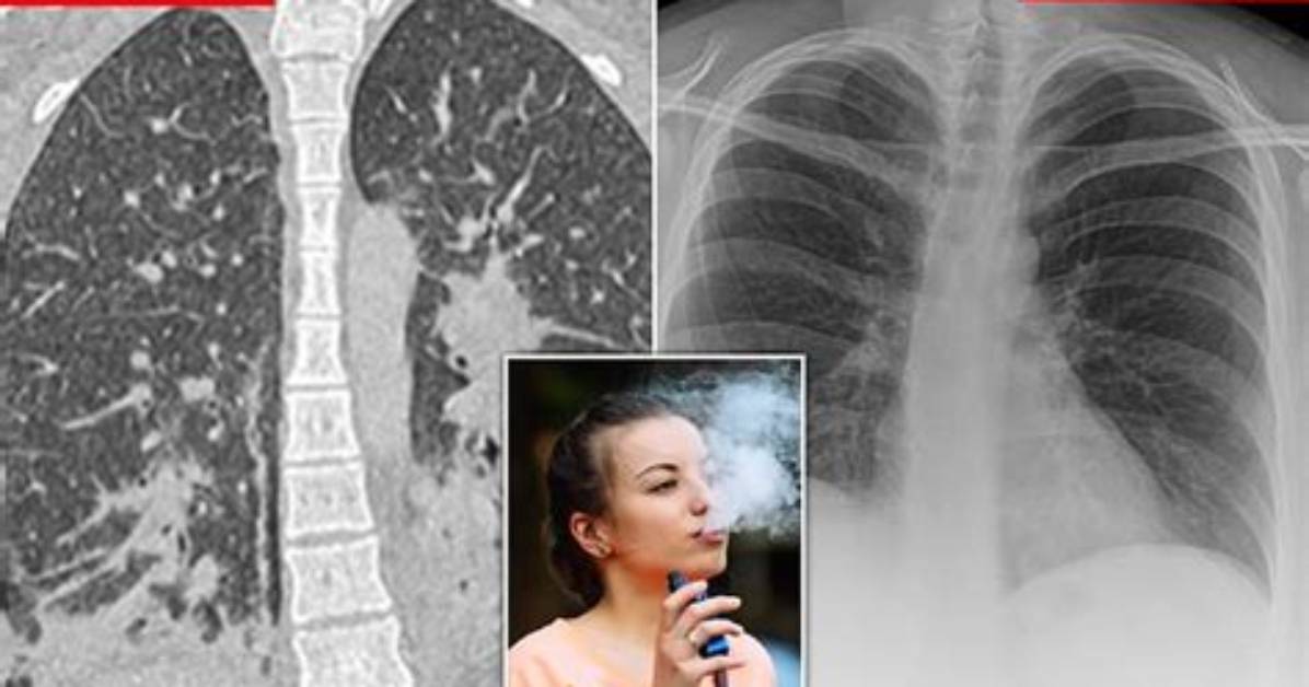What Do Vapes Do to Your Lungs?