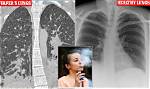 What Do Vapes Do to Your Lungs?