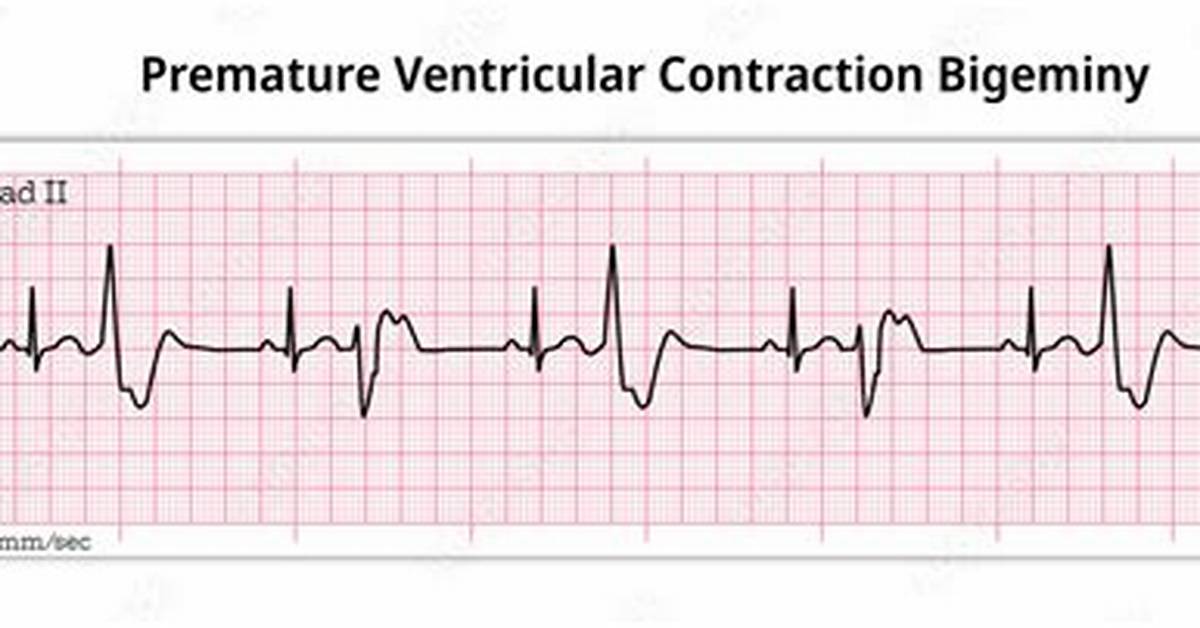 What Does a Bigeminy Pulse Mean?