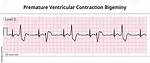 What Does a Bigeminy Pulse Mean?