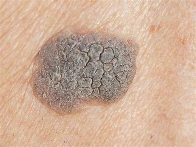 What Does a Crusty Wart Look Like?