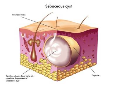 What Does a Cyst Smell Like?