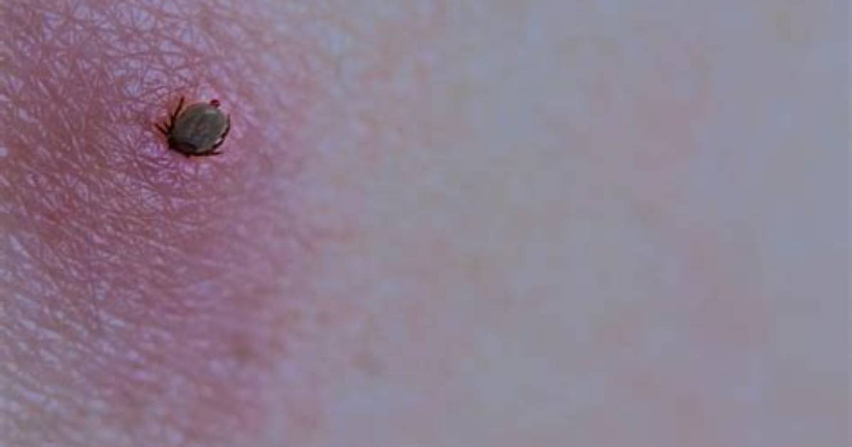 What Does a Deer Tick Bite Look Like?