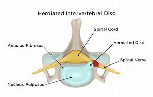 What Does a Herniated Cervical Disc Feel Like?
