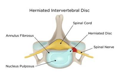 What Does a Herniated Cervical Disc Feel Like?
