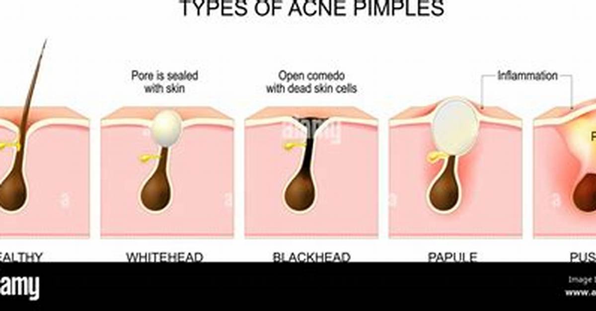 What Does a Pustule Look Like?