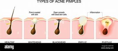 What Does a Pustule Look Like?