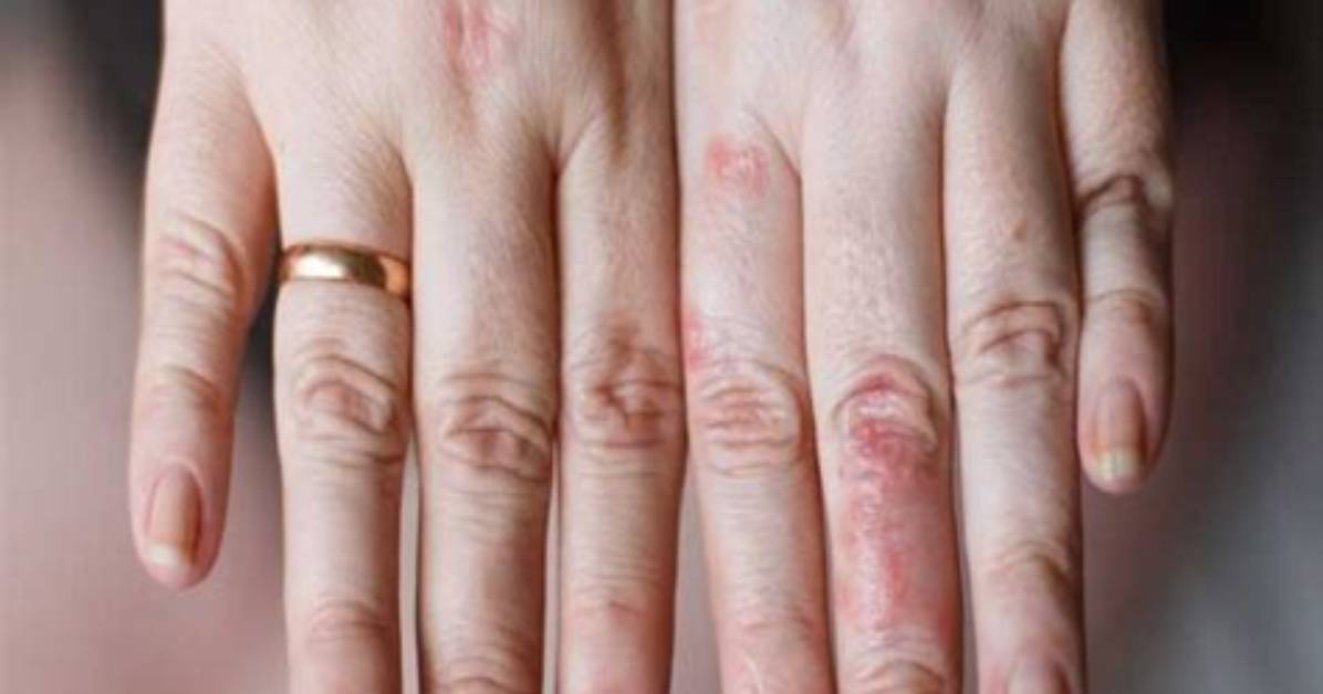 What Does an Allergic Reaction to Laundry Soap Look Like?