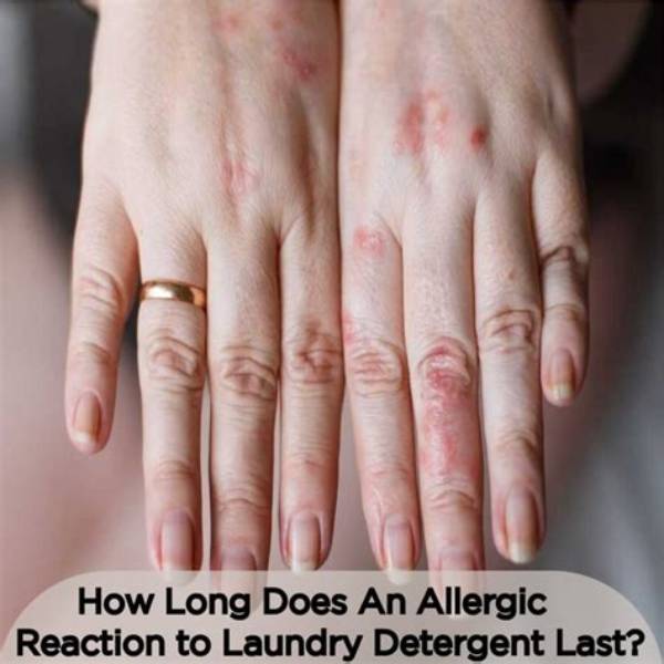 What Does an Allergic Reaction to Laundry Soap Look Like?