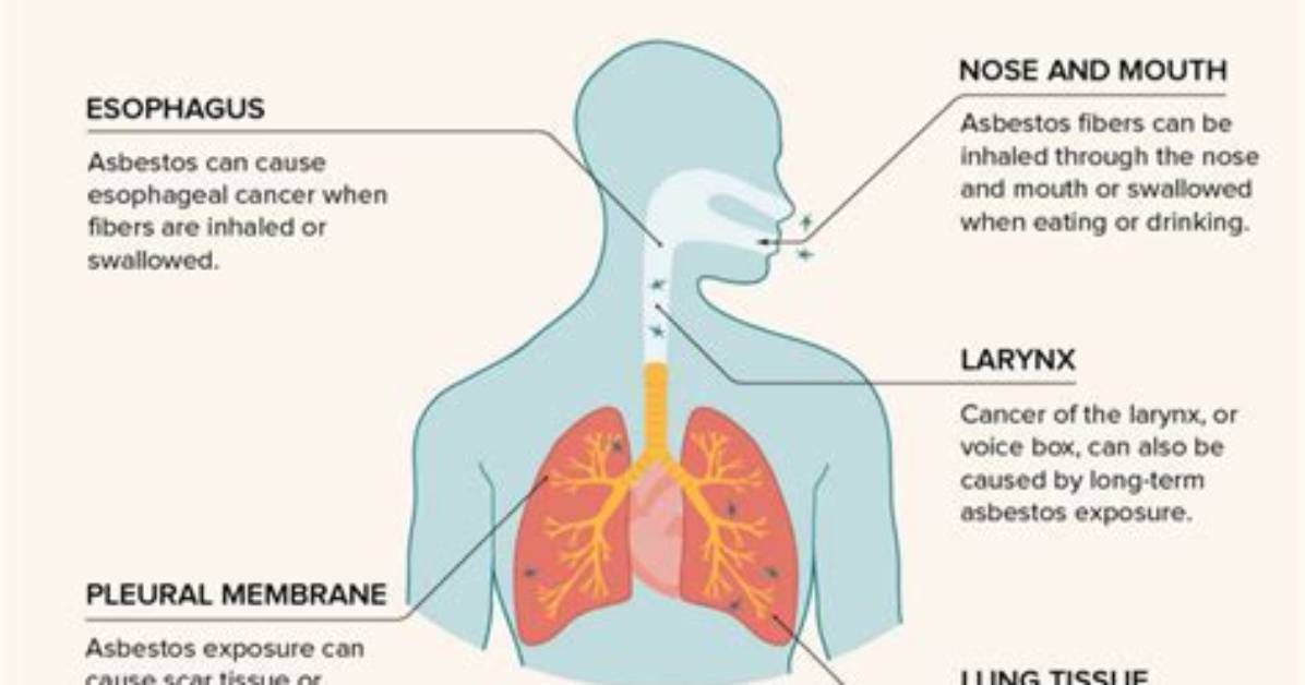 What Does Asbestos Poisoning Cause?