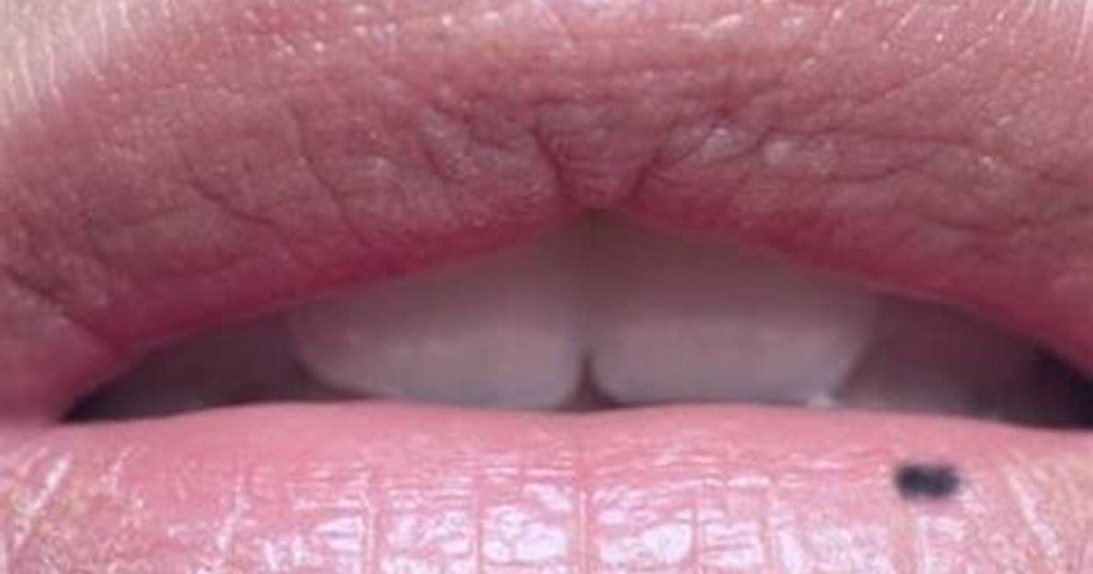 What Does Black Spot on Lower Lip Mean?