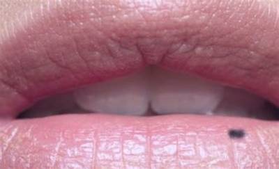 What Does Black Spot on Lower Lip Mean?