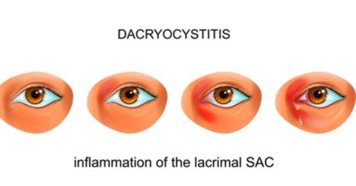 What Does Dacryocystitis Look Like?