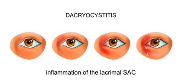 What Does Dacryocystitis Look Like?