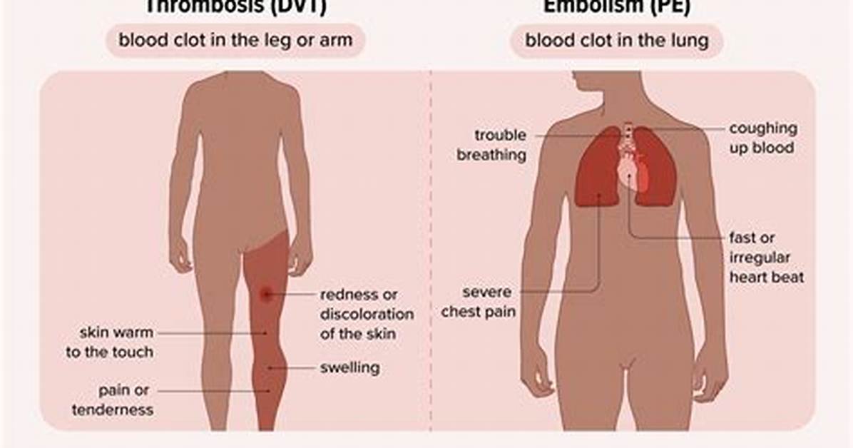 What Does Pain from a Blood Clot Feel Like?
