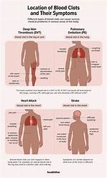 What Does Pain from a Blood Clot Feel Like?