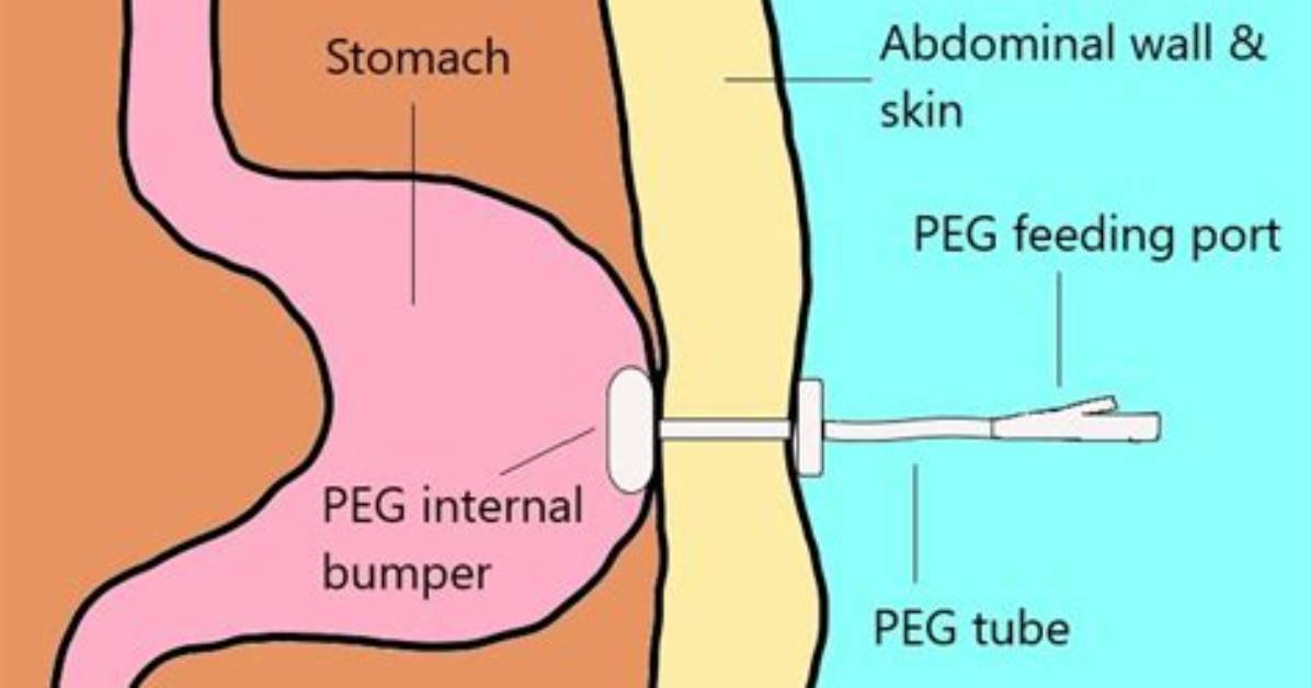 What Does Peg Stand for in the Army?