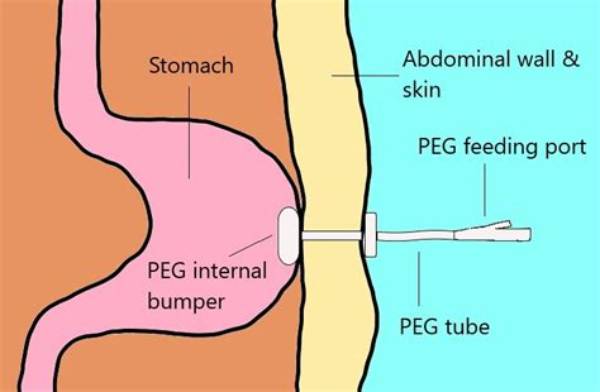 What Does Peg Stand for in the Army?