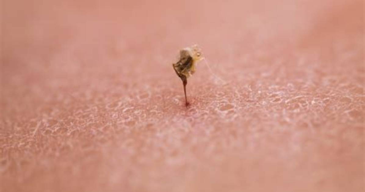 What Draws a Stinger out of Skin?